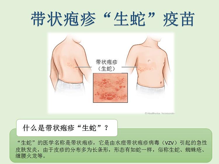 生蛇当作皮肤过敏医治?预防生蛇最有效的方法——生蛇疫苗