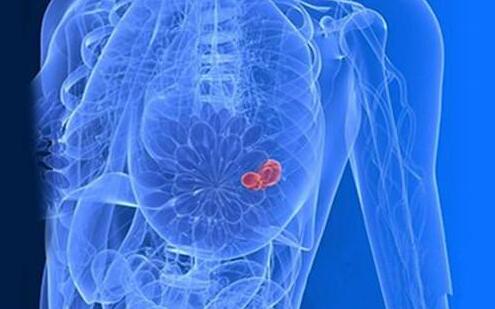 乳腺癌的早期症状