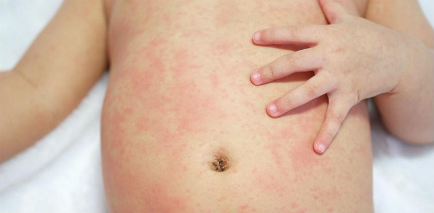 BB湿疹怎么办 找出致敏源不用烦!