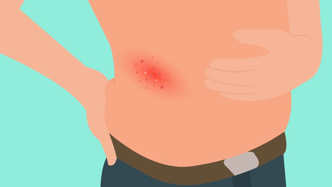 带状疱疹有多大的危害性