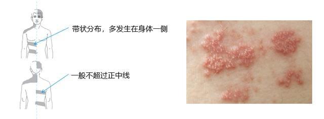 生蛇和湿疹的区别有哪些？