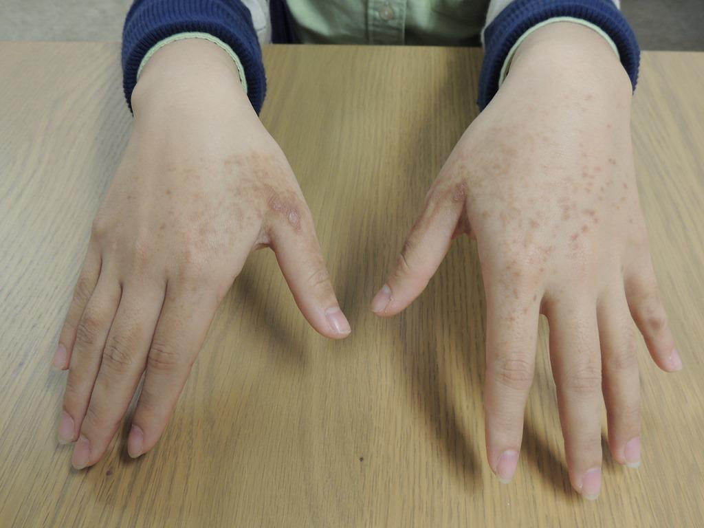 香港过敏测试方式有哪些？