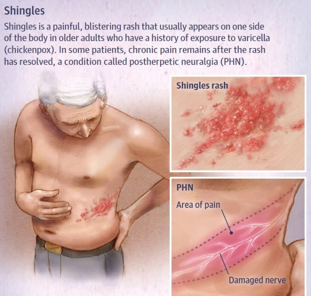 50岁以下人群如何预防带状疱疹？