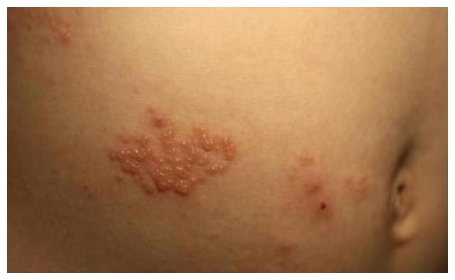 为什么生蛇痛起来会让人难以忍受？