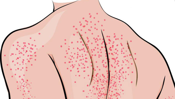 如何判断自己或家人得了带状疱疹？