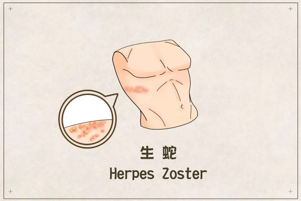 你会有生蛇的风险吗？得过水痘都有机会发作