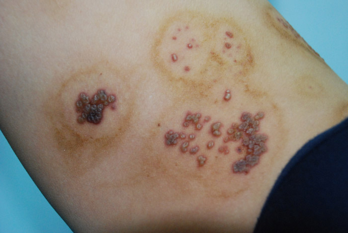 带状疱疹有多痛？