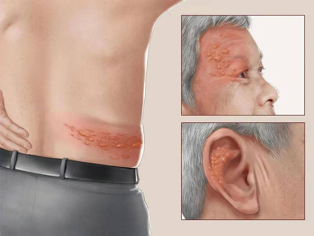 生蛇好发于什么季节？