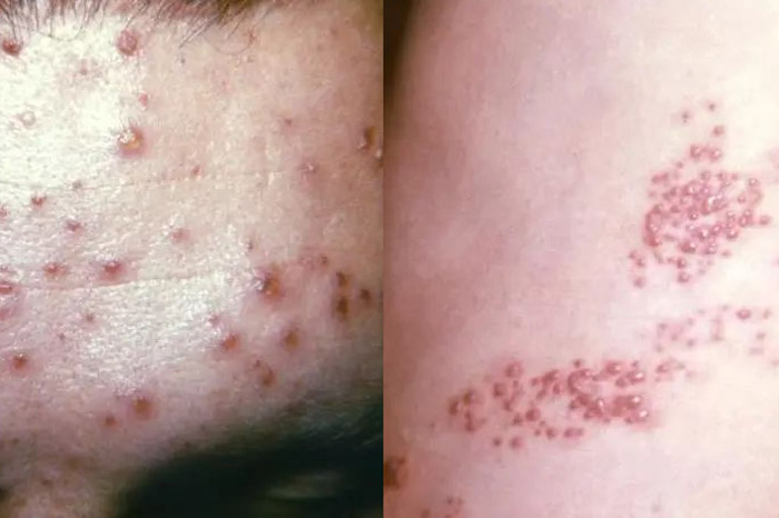 生蛇的症状有哪些？与水痘一样吗？