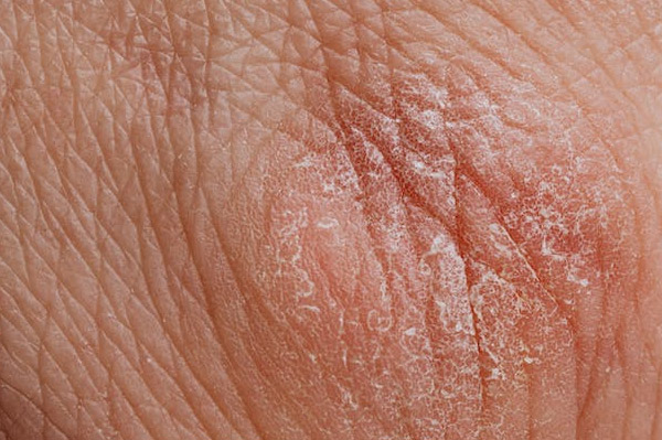 什么是生蛇？这病疼得让人记一辈子！