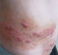 什么是生蛇？与水痘是亲兄弟