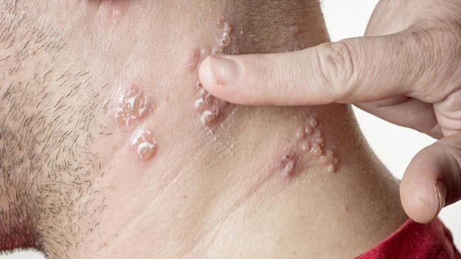 长者严防生蛇来袭,注射蛇针有助预防