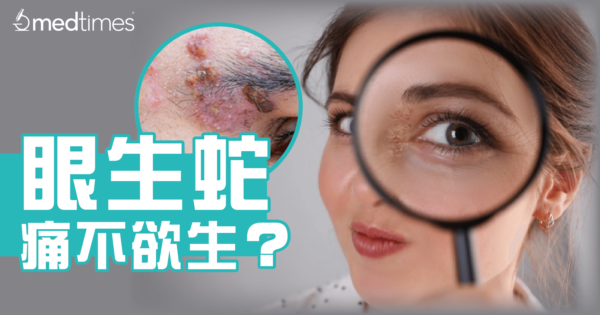 【生蛇须知】眼生蛇痛不欲生？了解成因与预防！